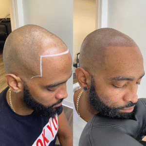 Scalp Micropigmentation