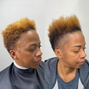 SMP for Alopecia